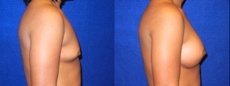 Right Profile View - Breast Augmentation