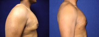 Right Profile View - Male Breast Reduction