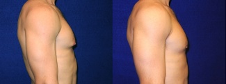 Right Profile View - Male Breast Reduction