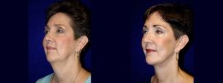 Left 3/4 View - Facelift & Chin Implant