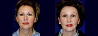 Full Frontal View - Facelift with Upper Eyelid Surgery and Browlift