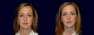 Full Frontal View - Rhinoplasty