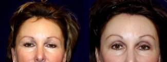 Frontal View - Upper Eyelid Surgery and Browlift