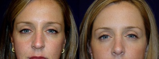 Frontal View - Rhinoplasty