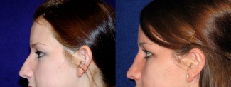 Left Profile View - Otoplasty