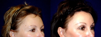 Right 3/4 View - Upper Eyelid Surgery and Browlift