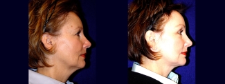 Full Right Profile View - Facelift with Upper Eyelid Surgery and Browlift