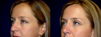 Left 3/4 View - Rhinoplasty