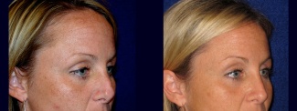 Right 3/4 View - Rhinoplasty