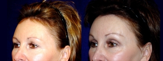 Left 3/4 View - Upper Eyelid Surgery and Browlift