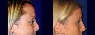 Right Profile View - Rhinoplasty