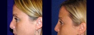 Left Profile View - Rhinoplasty