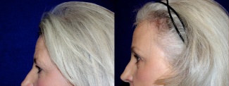 Right Profile View - Upper Eyelid Surgery with Browlift