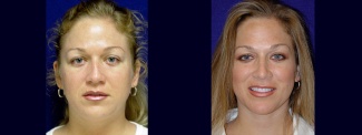 Frontal View - Rhinoplasty