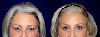 Fontal View - Upper Eyelid Surgery with Browlift