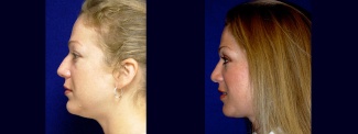 Left Profile View - Rhinoplasty