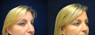 Right 3/4 View - Rhinoplasty