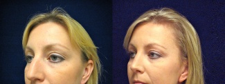 Left 3/4 View - Rhinoplasty