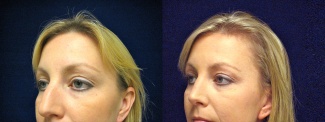 Left 3/4 View - Rhinoplasty