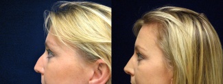 Left Profile View - Rhinoplasty