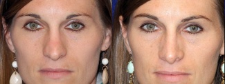 Frontal View - Rhinoplasty