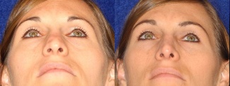 Frontal Low Angle View - Rhinoplasty