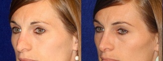 Left 3/4 View - Rhinoplasty