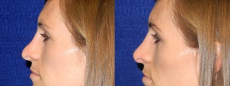 Left Profile View - Rhinoplasty