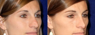 Right 3/4 View - Rhinoplasty