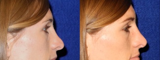 Right Profile View - Rhinoplasty