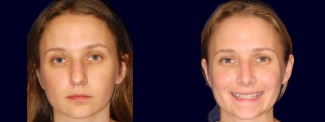 Frontal View - Rhinoplasty