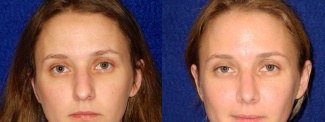 Frontal View - Rhinoplasty