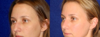 Left 3/4 View - Rhinoplasty