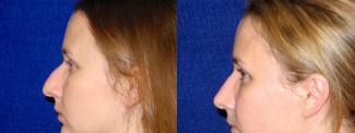 Left Profile View - Rhinoplasty