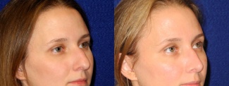 Right 3/4 View - Rhinoplasty