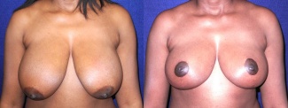 Frontal View - Breast Reduction