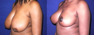 Left 3/4 View - Breast Reduction