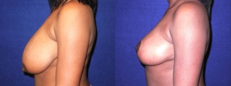 Left Profile View - Breast Reduction