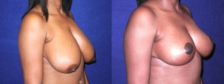 Right 3/4 View - Breast Reduction