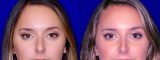 Frontal View - Rhinoplasty