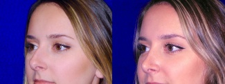 Left 3/4 View - Rhinoplasty