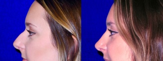 Left Profile View - Rhinoplasty