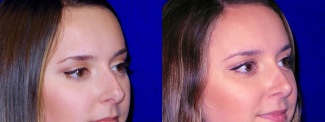 Right 3/4 View - Rhinoplasty