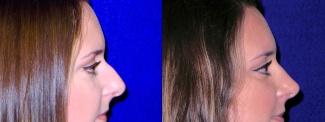 Right Profile View - Rhinoplasty