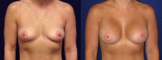 Frontal View - Breast Augmentation - Silicone Implants