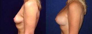 Left Profile View - Breast Augmentation - Silicone Implants