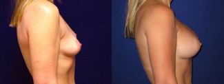 Right Profile View - Breast Augmentation - Silicone Implants