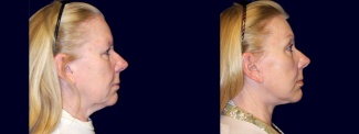 Right Profile View - Facelift, Eyelid Surgery, & Browlift