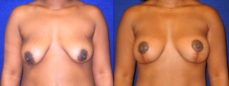 Frontal View - Breast Augmentation with Lift After Pregnancy