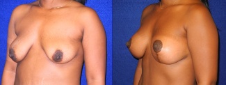 Left 3/4 View - Breast Augmentation with Lift After Pregnancy